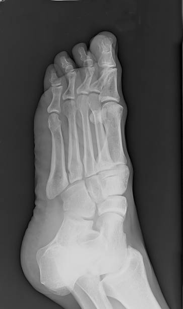 Left Foot Side X-Ray stock photo