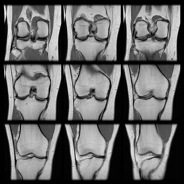 Series of MRI knee scans torn ACL adult human female A series of nine MRI shots from one scan, showing a human female's left knee showing a torn ACL ligament. posterior cruciate ligament stock pictures, royalty-free photos & images