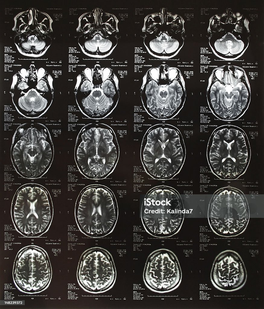 頭 x 線プレート - MRI検査のロイヤリティフリーストックフォト