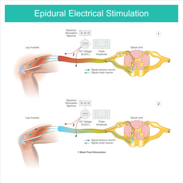 epidurale elektrische stimulation. muskelschmerzsymptom im beinbereich und behandlung durch elektrische stimulation auf der haut und dann vorbei an den beinmuskeln und nerven. - urethral sphincter stock-grafiken, -clipart, -cartoons und -symbole