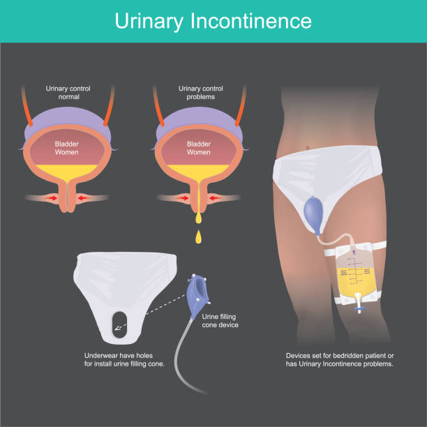 Urinary Incontinence. Urine filling cone device for bedridden patient or has Urinary Incontinence problems. vector art illustration