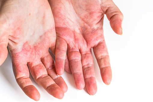 Atopic dermatitis, Highly allergic woman's hands, Red and cracked skin, Allergy problems, Health problems and autoimmune diseases, close up, white background