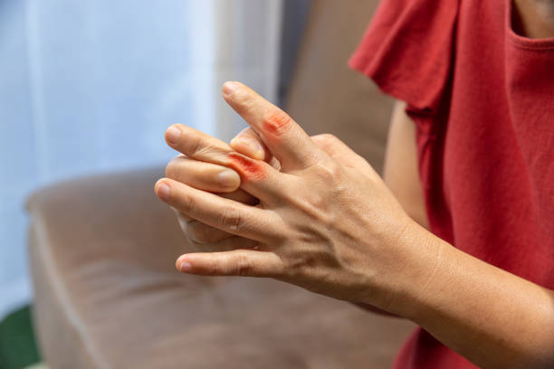 Senior Woman massage finger with painful swollen gout stock photo
