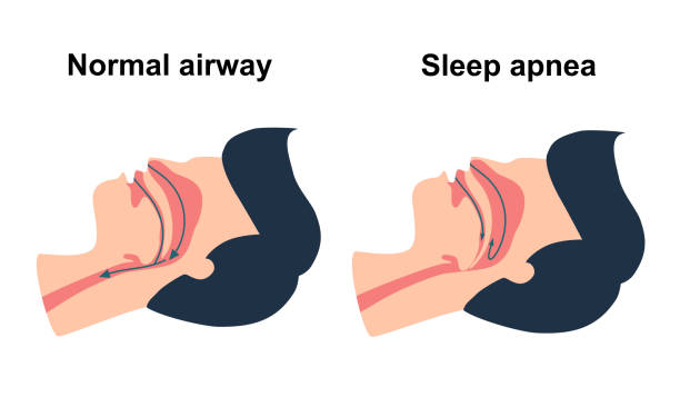 Obstructive sleep apnea syndrome concept vector illustration. vector art illustration