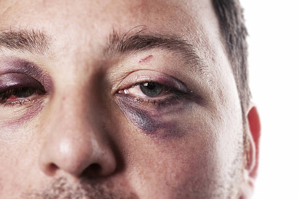 black eye injury accident violence isolated eye injury, male with black eye isolated on white. man after accident or fight with bruise bruise photos stock pictures, royalty-free photos & images