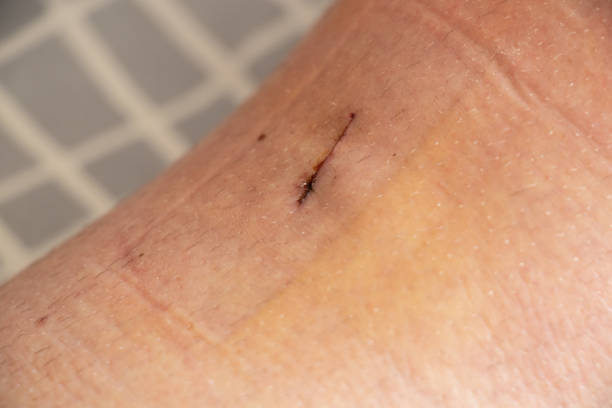 istock Postoperative sutures on the knee and leg after meniscus replacement in a man, stitched incisions on the skin of the leg 1482675132