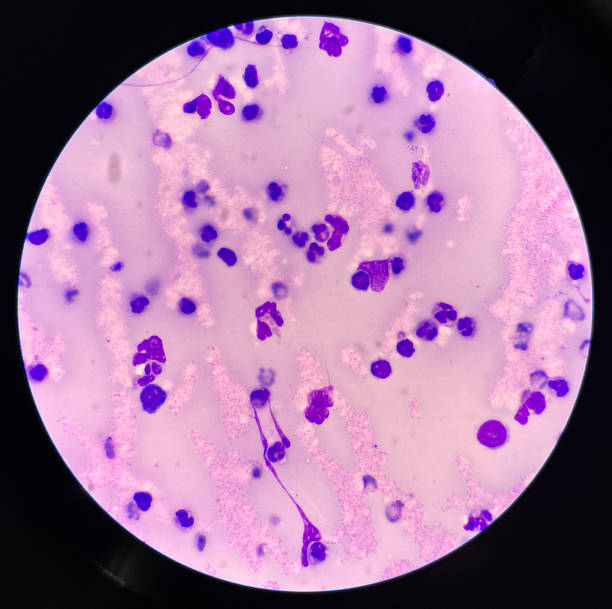 istock Neutrophil in synovial fluid inframatory cells. 1482756961
