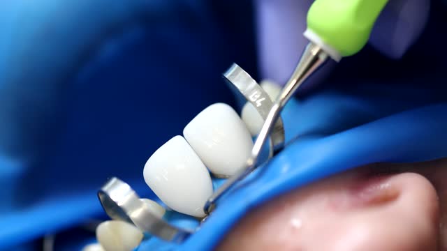 Dentist removes white ceramic veneers from teeth of patient