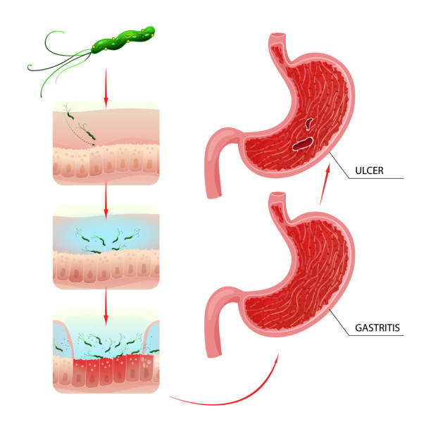 гастрит и процесс развития язвы желудка - peptic ulcer stock illustrations