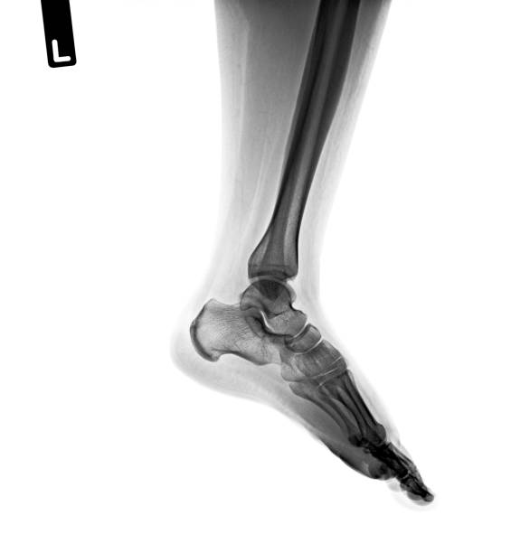 istock X-ray normal human of foot . 1482860664