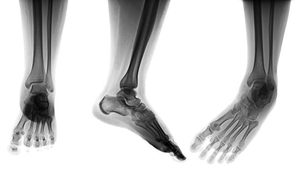 istock X-ray normal human of foot . 1482860687