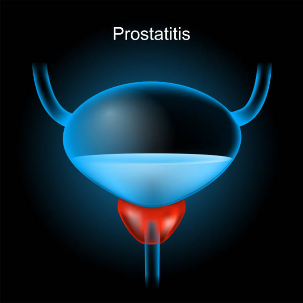 illustrations, cliparts, dessins animés et icônes de prostatite. prostate rouge et vessie bleue réaliste - prostate gland