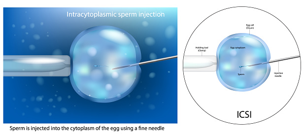 The procedure of Intracytoplasmic sperm injection ICSI. Artificial insemination in vitro fertilization. IVF macro. Scientific Diagram