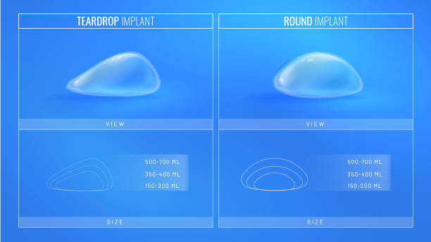 ilustraciones, imágenes clip art, dibujos animados e iconos de stock de tipos de implantes mamarios para cirugía plástica en un estilo realista. concepto de infografía para banner de clínica de cirugía plástica. ilustración vectorial en estilo futurista con efectos de luz - silicona