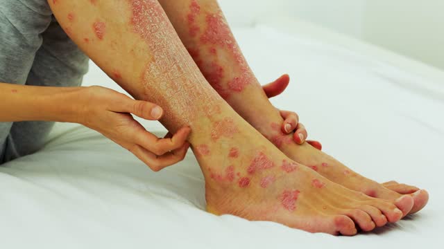 Severe exacerbation of psoriasis. Itching and pain, scratching of wounds.