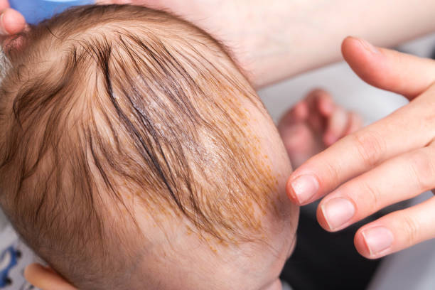 Smearing a seborrheic crust with baby oil on a child's head. Combing and removal of seborrheic crust, close-up Smearing a seborrheic crust with baby oil on a child's head. Combing and removal of seborrheic crust. 6-11-months stock pictures, royalty-free photos & images