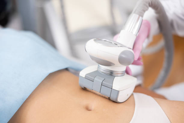 istock LPG massage device applied on young woman's belly 1483139537