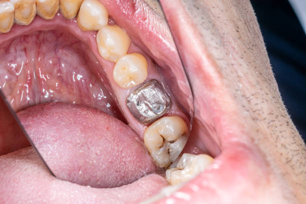 istock Metallic dental crown core build-up restoration. 1483142503