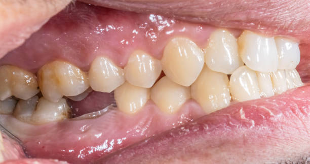 istock Lateral view of dental arches in occlusion with a lower molar decayed and destroyed crown. 1483145612