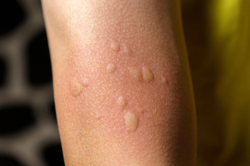 Síntomas de alergia, después de la inyección. Parte edematosa, sitio de punción roja. photo