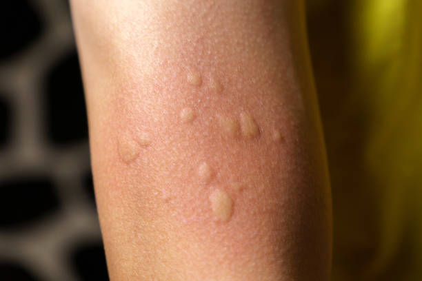 Close-up of Mosquito bite on a female adult arm on nature background on selective focus