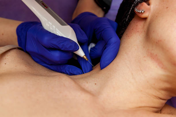 istock Removal of papillomas on the body 1483233810