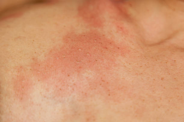 istock Removal of papillomas on the body 1483233822