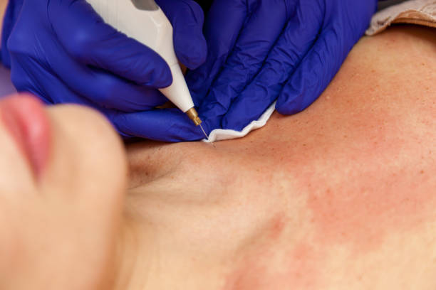 istock Removal of papillomas on the body 1483234743
