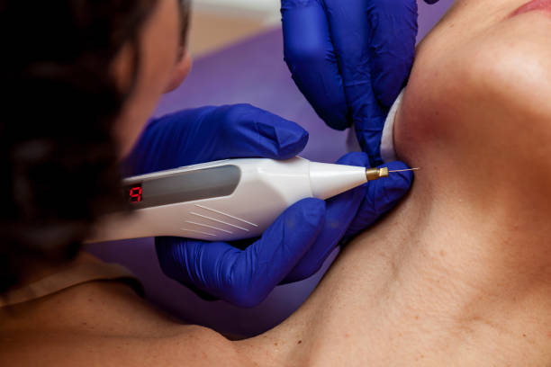 istock Removal of papillomas on the body 1483234770
