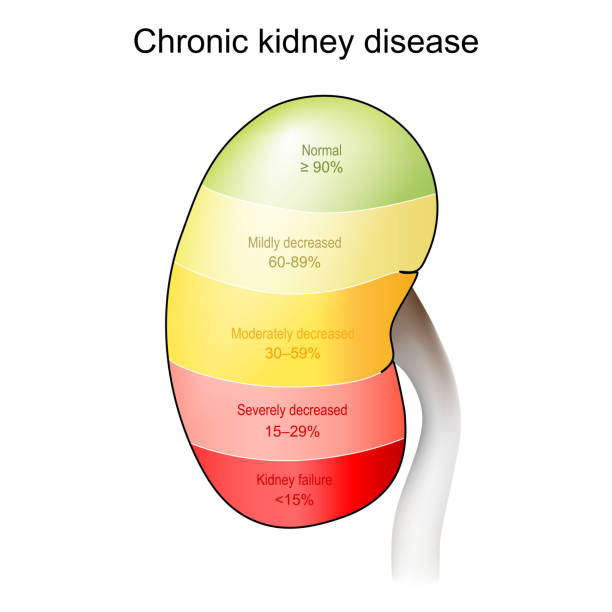 Chronic kidney disease. Stage of disorder Chronic kidney disease. Stage of disease from Normal and Mildly decreased, to Kidney failure. eGFR test result and how kidneys to filter of blood. vector illustration erythropoietin stock illustrations