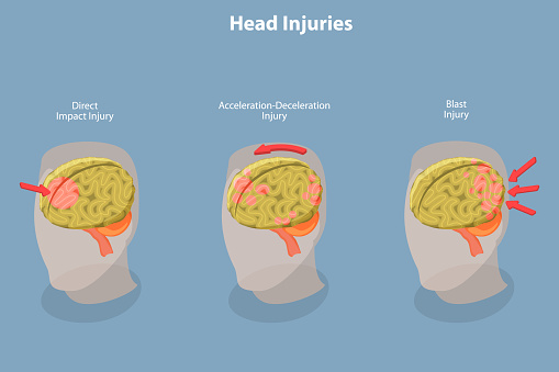 3D Isometric Flat Vector Conceptual Illustration of Brain Injuries, Head Trauma Scheme