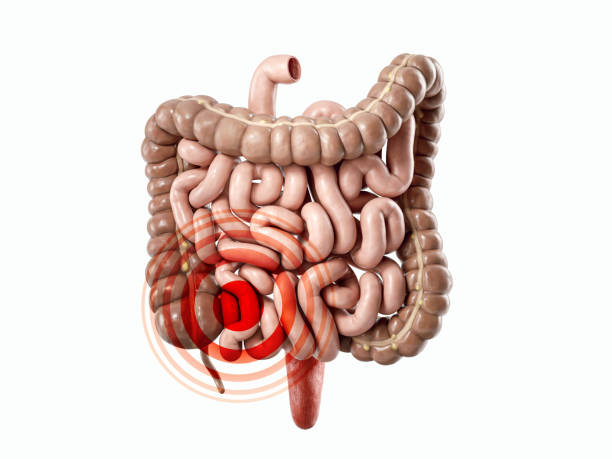 istock 3d illustration of sick human intestine 1483298749