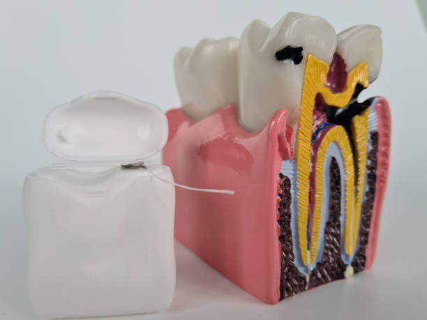 istock Dental care and teeth model with caries and dental 1483300330