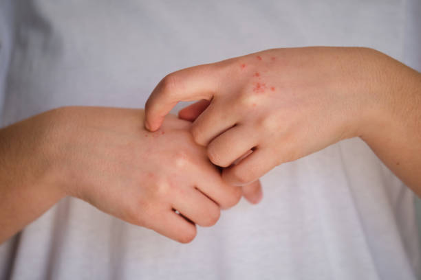 istock Woman scratching itchy eczema on her hand. 1483472133