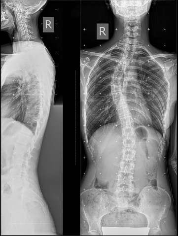 Panoramic x-ray of the spine in two projections. Single-arc right-sided deformity of the thoracic spine. coronary imbalance. X-ray of the spine with curvature in the thoracic region.
