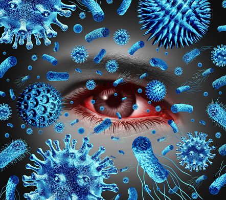 Conjunctivitis Eye Infection or infected Pink eyes as a bacterial and viral infections or allergic reaction and allergies as an opthamology or optometry symbol with 3D illustration elements.