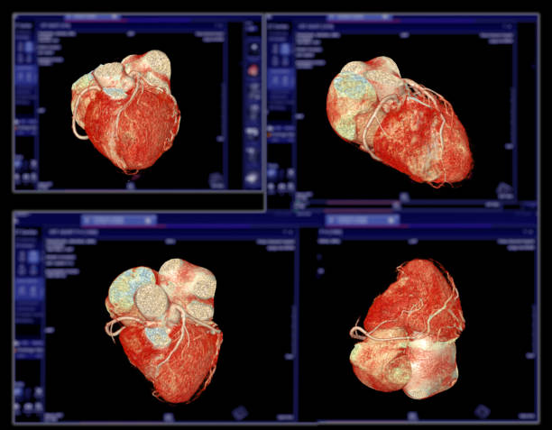CTA Coronary artery  3D rendering image. stock photo