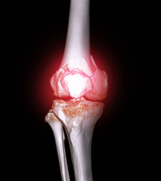 CT scan of knee joint 3D rendering image  showing fracture of distal femur bone. stock photo