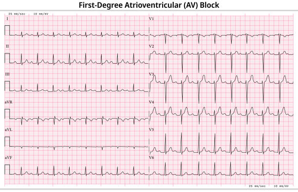 illustrazioni stock, clip art, cartoni animati e icone di tendenza di ecg blocco atrioventricolare di primo grado - blocco av di 1° grado - caso comune ecg a 12 derivazioni - 6 sec/derivazione - human heart pulse trace heart valve cardiac conduction system