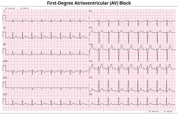 Vector illustration of ECG First Degree Atrioventricular Block - 1st degree AV Block - 12 Lead ECG Common Case - 6 Sec/lead