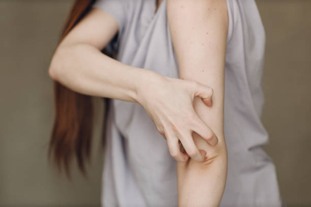 Allergy dermatology scabies itches skin problem woman Allergy dermatology scabies itches hand skin problem woman scab arm stock pictures, royalty-free photos & images