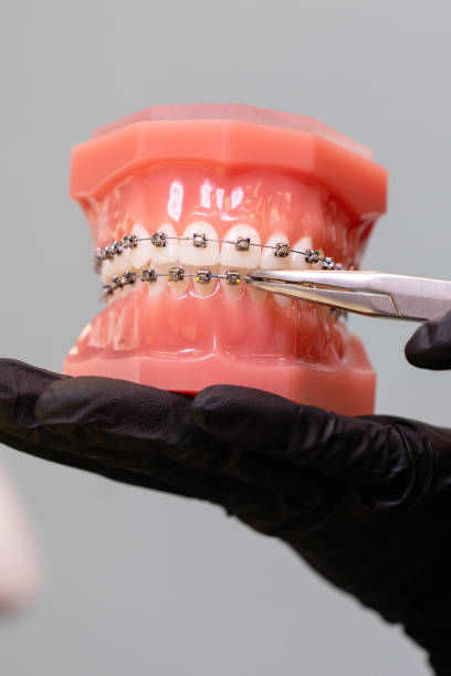 close-up shot of doctors hands in black gloves holding models of teeth with ceramic braces on teeth on an artificial jaw. - human teeth defending dental equipment brushing imagens e fotografias de stock