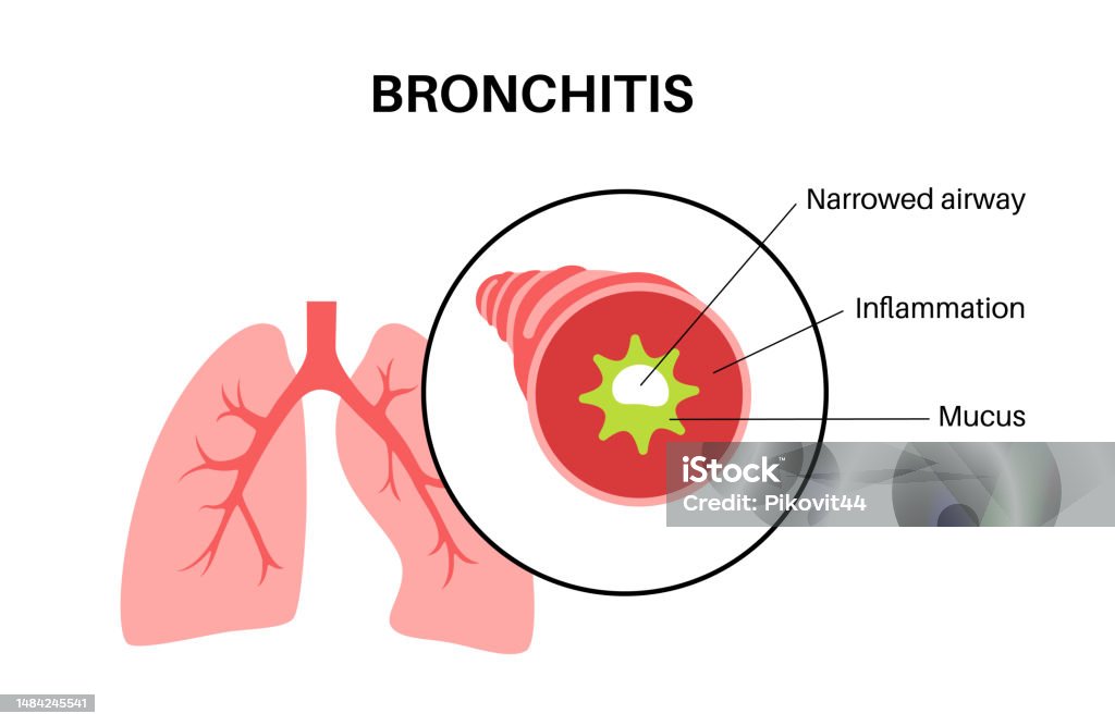 Christopher's Lung And Bronchial Side Effects Bronchitis Lung Disease Stock Illustration - Download Image Now