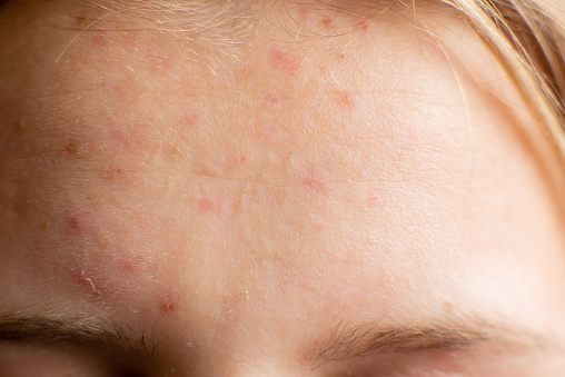 Pimples on forehead of teenager girl. Close-up of skin with inflammation. Adolescence, adolescence. Close-up. Small pimples all over surface of forehead.