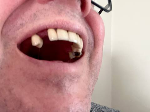 Senior man showing missing teeth