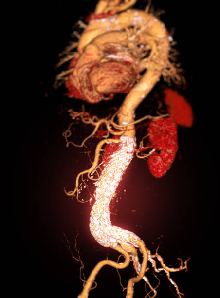 istock CTA whole aorta with Abdominal aorta stent graft 3D rendering image in case  abdominal aortic aneurysms. 1484479820