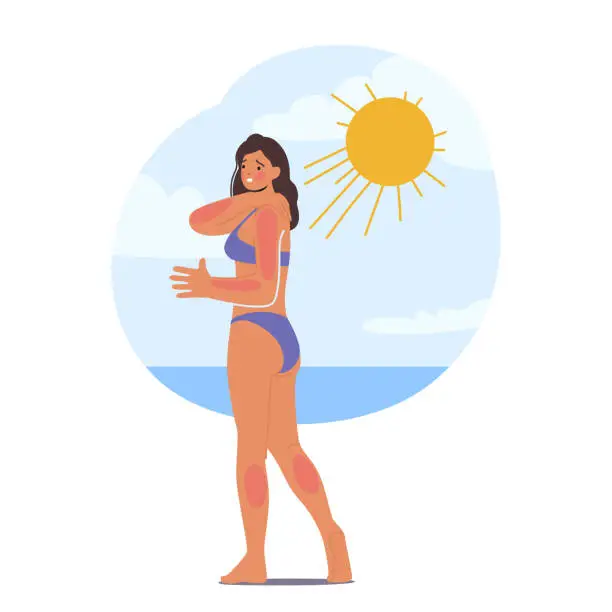 Vector illustration of Woman Experience Skin Sunburn On Beach Due To Excessive Sun Exposure. Skin of Female Character Appears Red And Irritated
