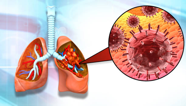 istock Virus infection in human lungs 1484766346