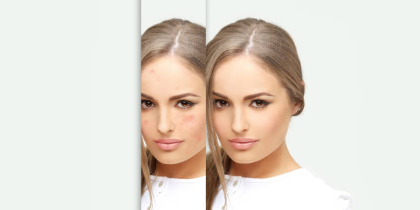 istock Post-Acne Marks .Treating Acne Scars.Acne Scar Removal 1484827900