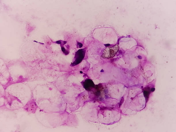 istock Microscopic analysis showing Epidermal inclusion cyst, swelling of left thigh 1484832245